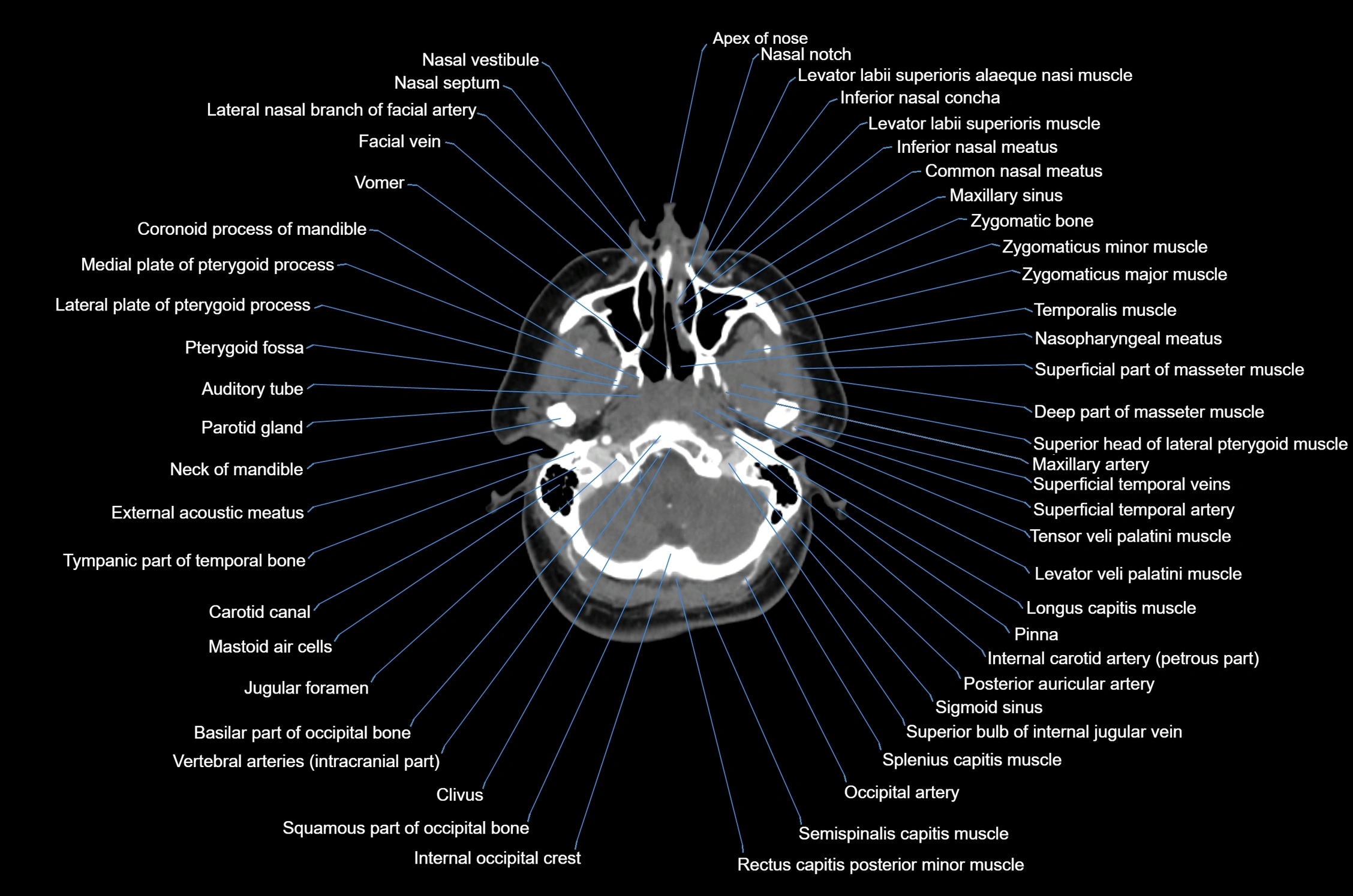 CT Neck axial cross sectional anatomy radiology image-img-00001-00017.webp